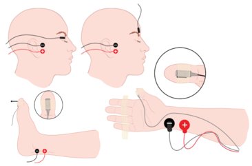 Klebeelektroden angebracht am Kopf, Arm, Finger und Fuß